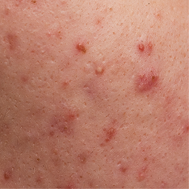 Small, clustered breakouts
