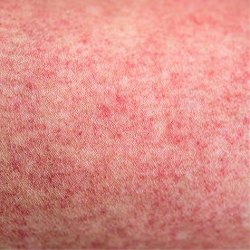 Slight redness or bumps